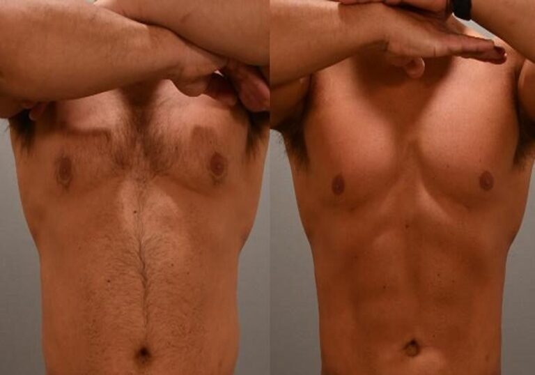 renuvion-skin-tightening-treatment-1001670-front-thumbnail-e1752514205970